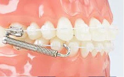 What Are Orthodontic Elastics (Rubber Bands) And How Do They Work