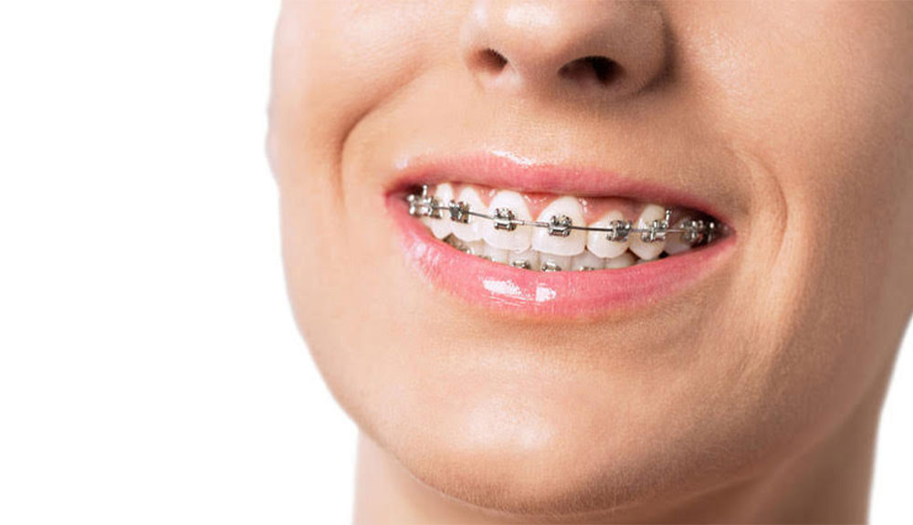 Types of Braces - McMillian Orthodontics