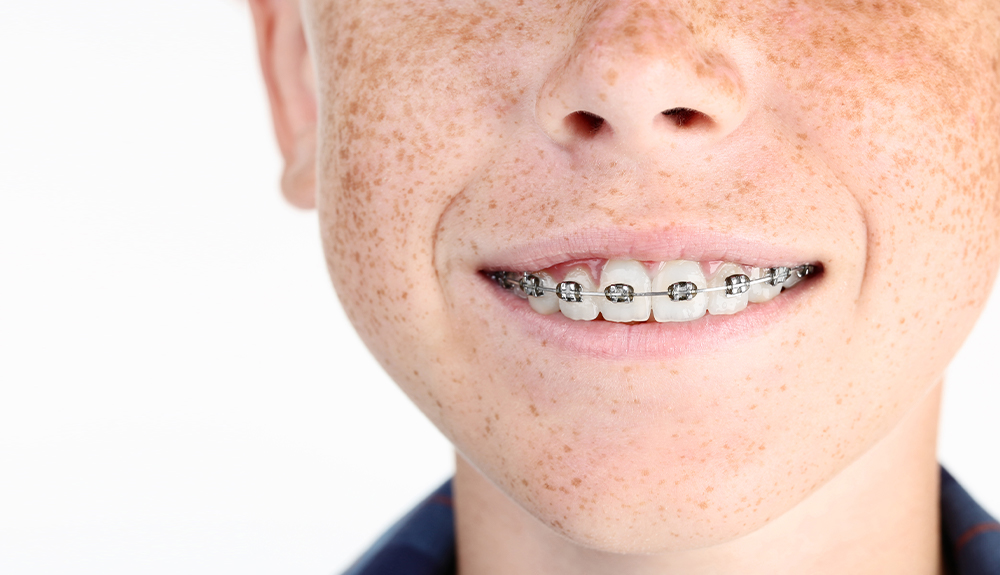 Types of Braces - McMillian Orthodontics